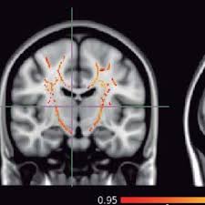 Piloto asistencial de anquilosamiento creative amiotrófica. Pdf Esclerosis Lateral Amiotrofica Contribucion De La Neurologia Mexicana De 1998 A 2014 Hr Martinez Me Meza Mt Gonzalez Garza Je Moreno Cuevas Revista Mexicana De Neurociencia 2014