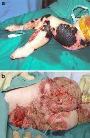 Mortality in pf is in excess of 50%. Figure 1 Management Of Extensive Cutaneous Necrosis Due To Meningococcal Septicaemia Purpura Fulminans With Topical Negative Pressure Tnp Suits Springerlink