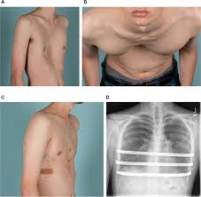 Image result for Pectus Excavatum