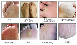 If you have localized callus or skin hardening, follow the procedures. Hot Packs Peeling Feet Mask Exfoliating Socks Care Pedicure Socks Remove Dead Skin Cuticles Suso Socks For Pedicure Xtasoft It Solutions