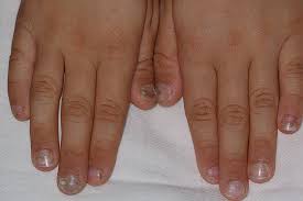 Hand Mund Fuss Krankheit Symptome Bilder Behandlung Familie De