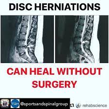 Maybe you would like to learn more about one of these? Repost From Sportsandspinalgroup Can Discs Heal Disc Healing Key Point Disc Herniations Are Common In The Majority First Principles Of Movement