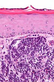 Reconstruction after surgery for skin cancer. Merkel Cell Carcinoma Wikipedia