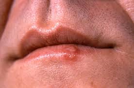A face rash could be caused by many different things. Oral Stds Pictures Types Symptoms Treatment And Prevention