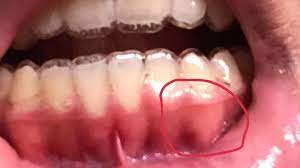 I Just Got My Retainers Yesterday And My Gum Turned White Then After A Few Mins It S Pink Is That Normal And I Also Have Gotten A Scratch From This Should I