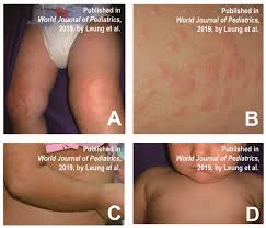 Image result for Hand foot and mouth disease HFMD roof of mouth