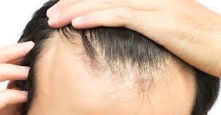 Hair in areas behind the hairline might also start to thin. Receding Hairline Treatment Stages And Causes