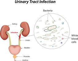 How To Recognize Uti Causes And Symptoms Of A Uti In 2020 Urinary Tract Infection Treatment Uti Treatment Essential Oils For Uti