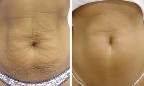 How To Get Rid Of Loose Skin After Pregnancy