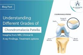 Image result for Patella Mobility Test