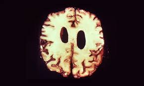 Image result for Neurosyphilis