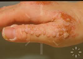 Image result for verrucae filiformes