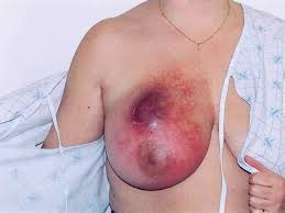 Image result for breast cancer