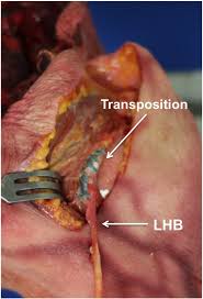 He has not been wearing his sling and reports that he developed increased pain after slipping in the shower. Transfer Of The Long Head Of Biceps To The Conjoint Tendon A Biomechanical Study Clinical Biomechanics