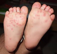 Image result for Hand foot and mouth disease HFMD roof of mouth
