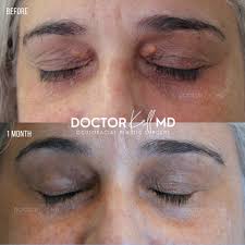 Image result for xanthelasma of eyelid