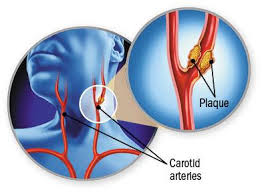 Image result for carotid artery