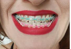 Black And White Braces Color Pin By Iyeyonna On Braces Dental Braces Braces Colors Cute Braces