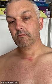 Cyclist is left bloodied and bruised after smashing into wire booby trap