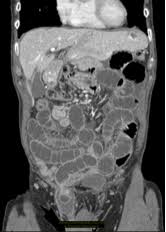 Image result for Hernia Reduction