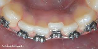Maybe you would like to learn more about one of these? Crooked Bottom Teeth Made Straighter With Braces Kendall Park Nj