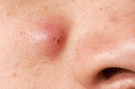 cysts on skin pictures of what they