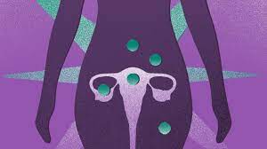 The most common symptom they had was hot flushes, which could be mild or brief 'tropical moments' but for some were dramatic and debilitating. Managing Ovarian Cancer Pain Everyday Health