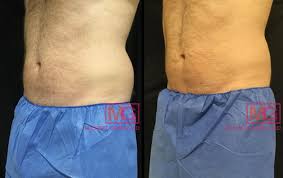 Check spelling or type a new query. Coolsculpting For Men In Nyc For Abs Flanks Arms And Legs