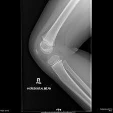 Image result for Knee XRay