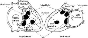 Image result for Ventricular Septal Defect