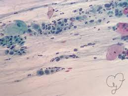 Cytology Zoom On Twitter High Grade Squamous Intraepithelial Lesion Hisl Note The Coarse Chromatin And Inconspicuous Nucleoli As Well As The Thickened Irregular Nuclear Outlines Nuclear To Cytoplasmic N C Are Almost 1 1 Cytology Zytologie