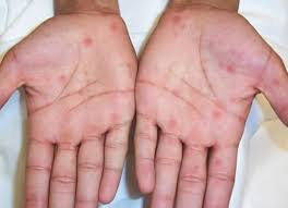 The most common route of transmission is through contact with an infected person's sore during sexual activity. Secondary Syphilis Palmar Lesions