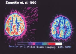 Adult Attention Deficit Hyperactivity Disorder Wikipedia