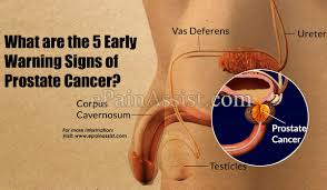 However, a growing tumor will eventually cause symptoms. What Are The 5 Early Warning Signs Of Prostate Cancer