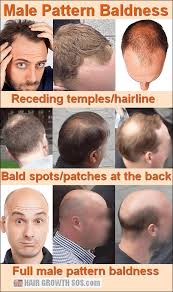 Hair loss occurs for a variety of different reasons. Why The Pattern In Male Pattern Baldness Develops