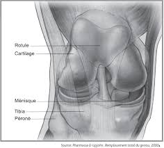 Un succès d'équipe!» conférence, dr jacques vallotton, avec julien rappaz et david conte. Prothese Totale Du Genou Ptg Chu De Quebec Universite Laval