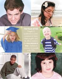 Maybe you would like to learn more about one of these? New Research Provides Hope For Fragile X Syndrome Treatment