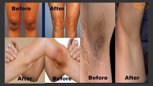 What are some ways to lighten my dark elbows? How To Lighten Your Dark Body Parts Lighten Dark Knees Elbows Underarms Youtube