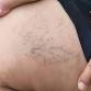 Various Aspects of Varicose Veins with Vascular event image