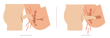 Describe louie's first experience with running for a sport. Faq Vaginismus