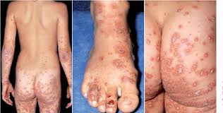Image result for Papular Acrodermatitis