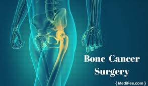 Although breast cancer can spread to any bone, the most common sites are the ribs, spine, pelvis, and long bones in the arms and legs. Bone Cancer Treatment Surgery Procedures Stages Risks And Recovery
