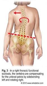 Hipflexor In 2020 Scoliosis Exercises Massage Therapy Scoliosis