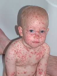Wind (wind) +‎ pocken ((small)pox). Windpocke Wiktionary