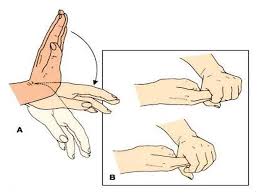 Asterixis (also called the flapping tremor, or liver flap) is a tremor of the hand when the wrist is extended, sometimes said to resemble a bird flapping its wings. Hepatic Encephalopathy Definition 1 Hepatic Encephalopathy He It Represents A Reversible Decrease In Neurological Function Based Upon The Disorder Ppt Download