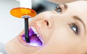 Bleach is the generic name for any chemical product that is used industrially and domestically to remove color from a fabric or fiber or to clean or to remove stains in a process called bleaching. Bleaching Professionelle Zahnaufhellung Familiendentist