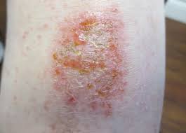 Tribulus is a plant that produces fruit covered with spines. What Is Causing These Oozing Crusting Plaques On A Man S Shins Consultant360
