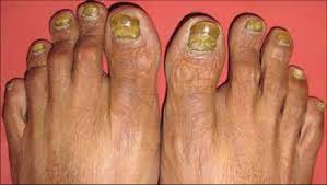 Image result for Yellow nail syndrome feet