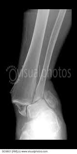 Ankle Fracture X Ray Stock Photos Royalty Free Royalty Free Photos Ankle Fracture X Ray Medical School Stuff