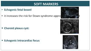 Antenatal Screening Tests And Prenatal Diagnosis Ppt Download